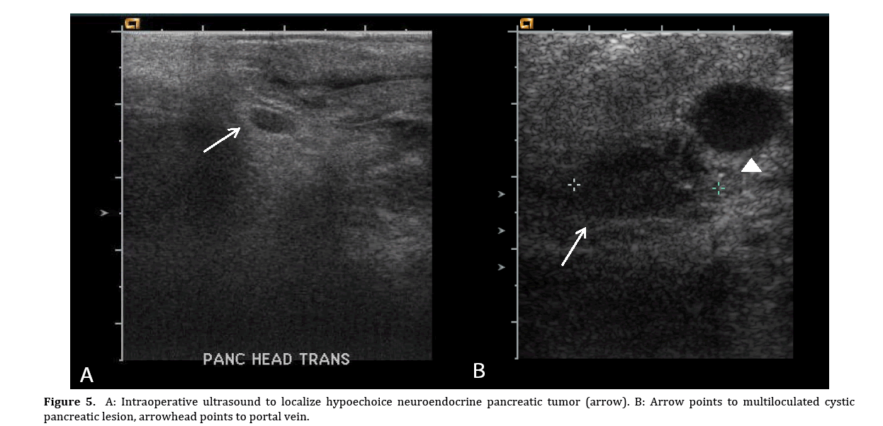 pancreas-intraoperative-ultrasound