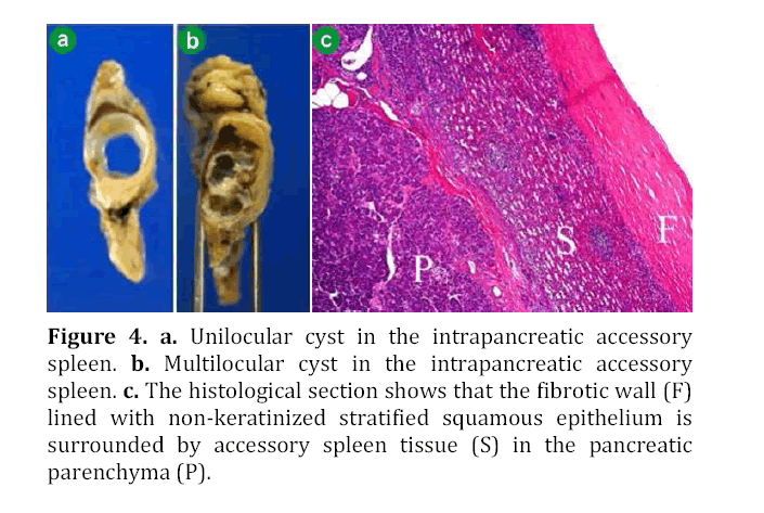 pancreas-intrapancreatic-accessory