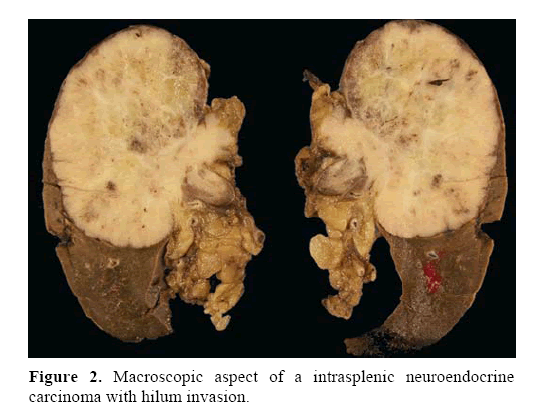 pancreas-intrasplenic-neuroendocrine