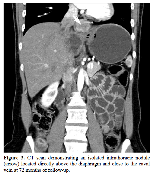 pancreas-intrathoracic-nodule-diaphragm