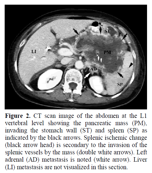 pancreas-invading-stomach-wall