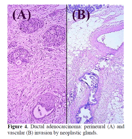 pancreas-invasion-neoplastic-glands