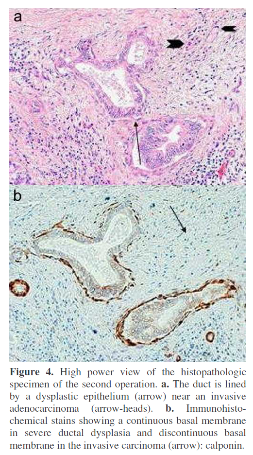 pancreas-invasive-adenocarcinoma