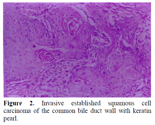 pancreas-invasive-established-squamous