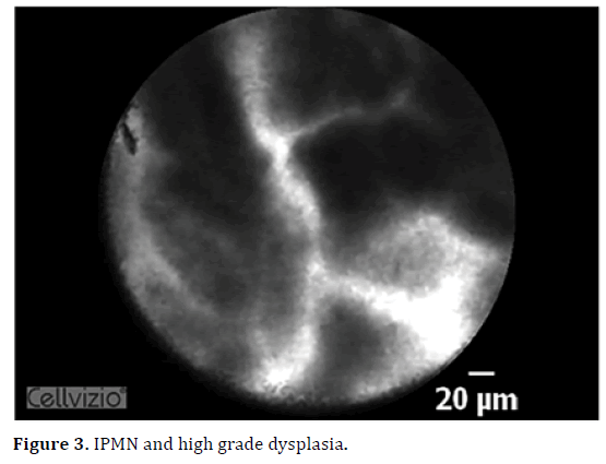 pancreas-ipmn-dysplasia