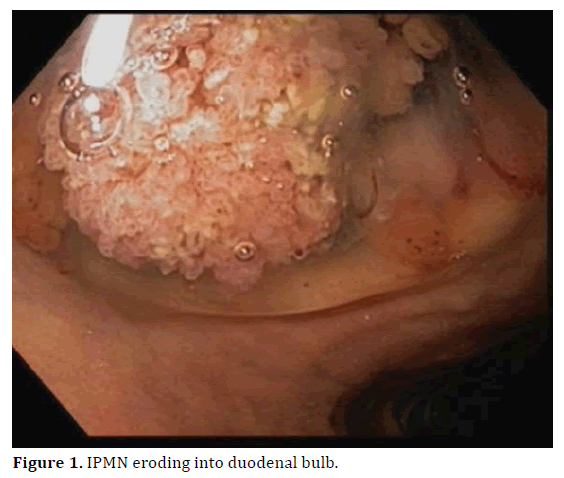 pancreas-ipmn-eroding-duodenal-bulb