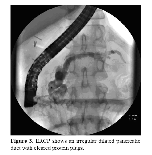 pancreas-irregular-dilated-pancreatic