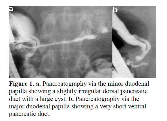 pancreas-irregular-dorsal-pancreatic