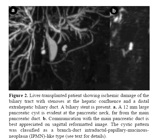 pancreas-ischemic-damage