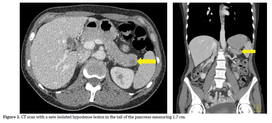 pancreas-isolated-hypodense-lesion