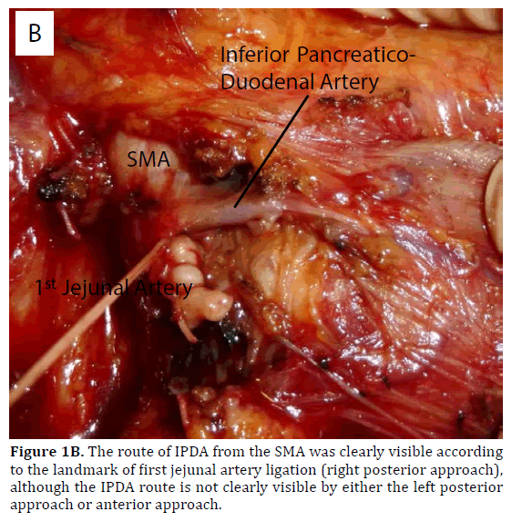 pancreas-jejunal-artery-ligation