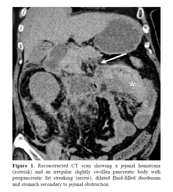 pancreas-jejunal-hematoma