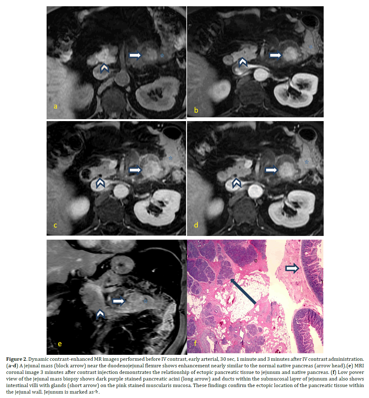 pancreas-jejunal-mass