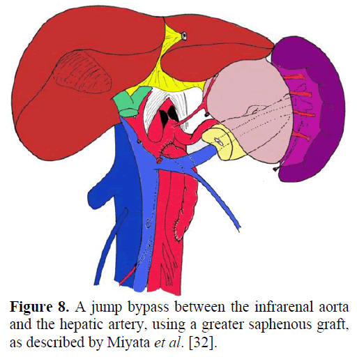 pancreas-jump-bypass-infrarenal-aorta