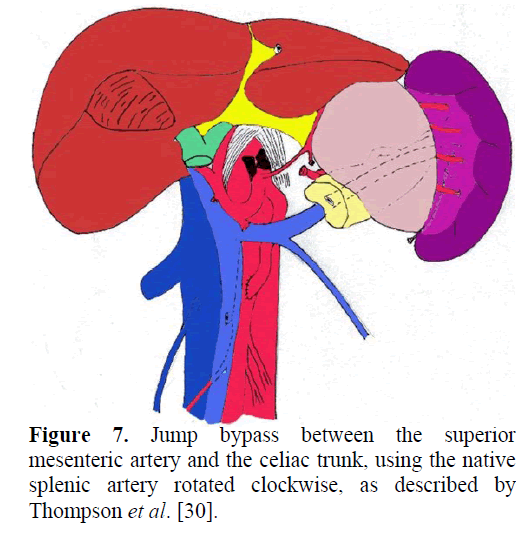pancreas-jump-bypass-mesenteric-artery
