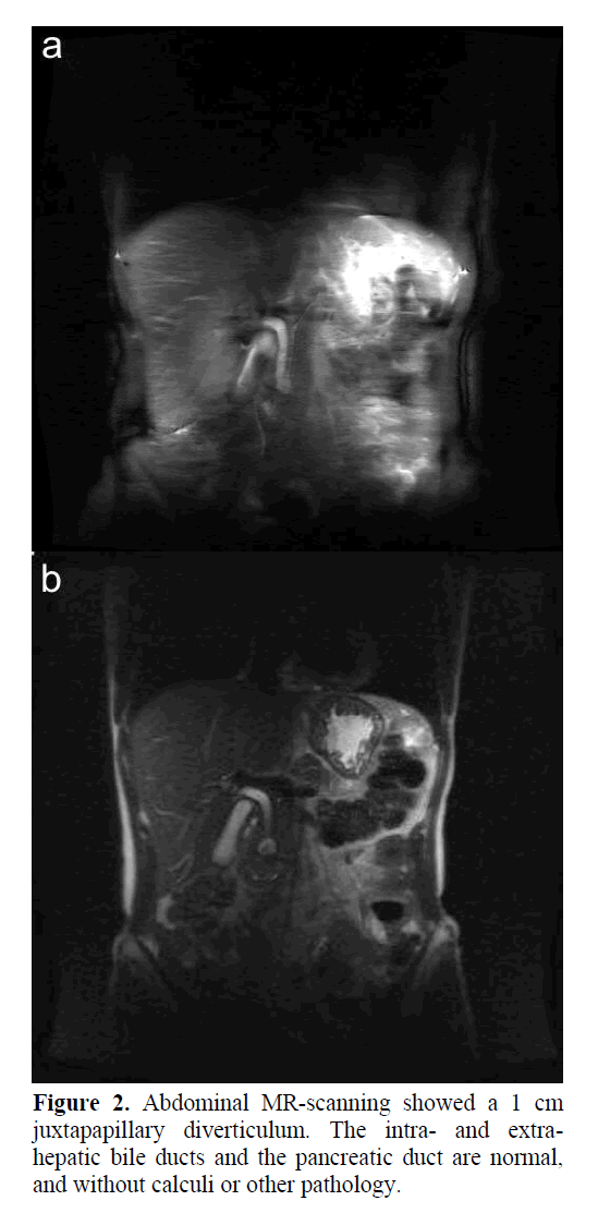 pancreas-juxtapapillary-diverticulum