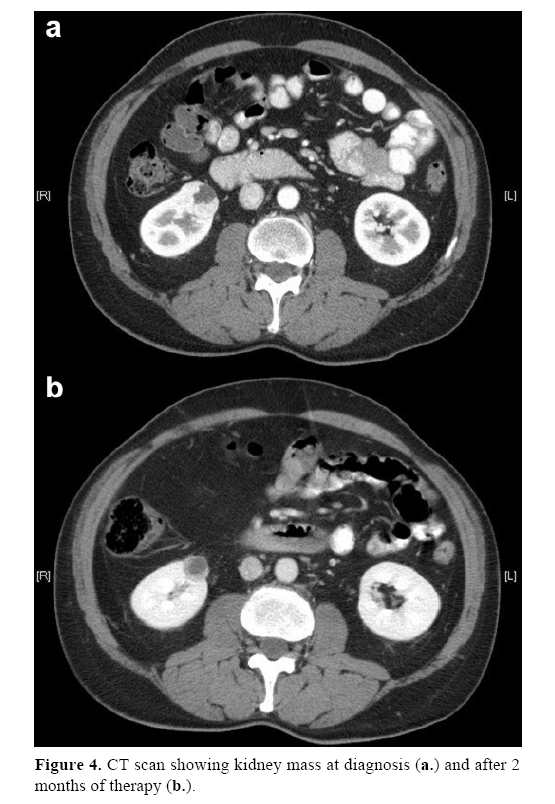 pancreas-kidney-mass-diagnosis
