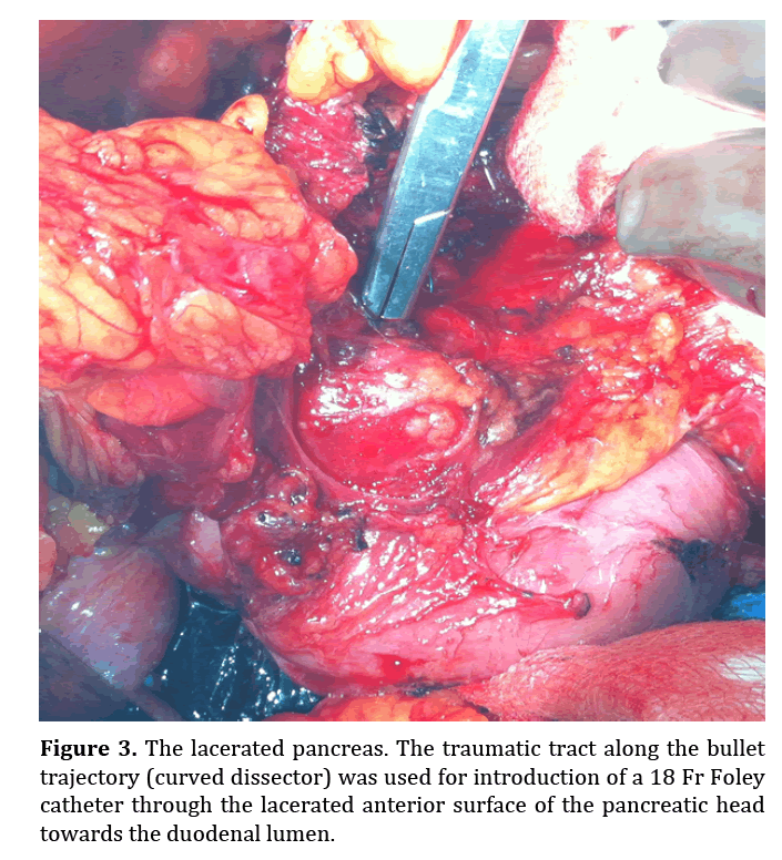 pancreas-lacerated-anterior-surface