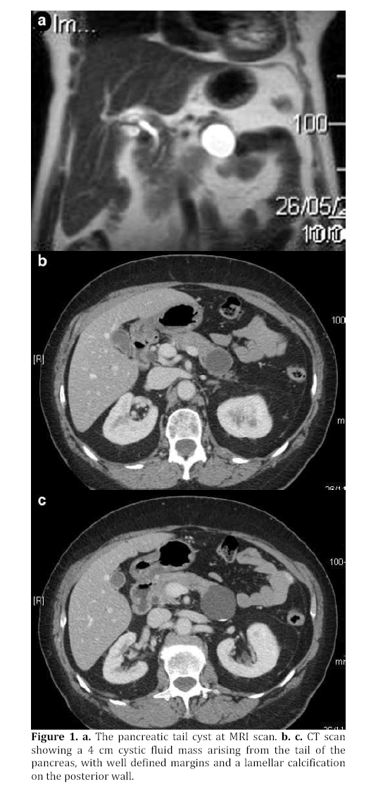 pancreas-lamellar-calcification