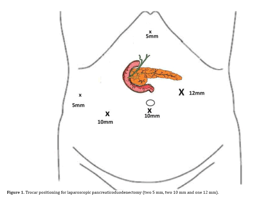 pancreas-laparoscopic