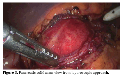 pancreas-laparoscopic