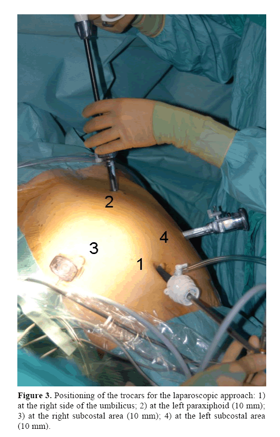 pancreas-laparoscopic-approach