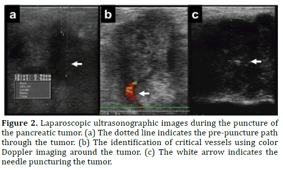 pancreas-laparoscopic-ultrasonographic