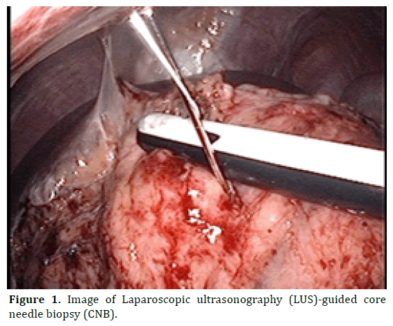 pancreas-laparoscopic-ultrasonography