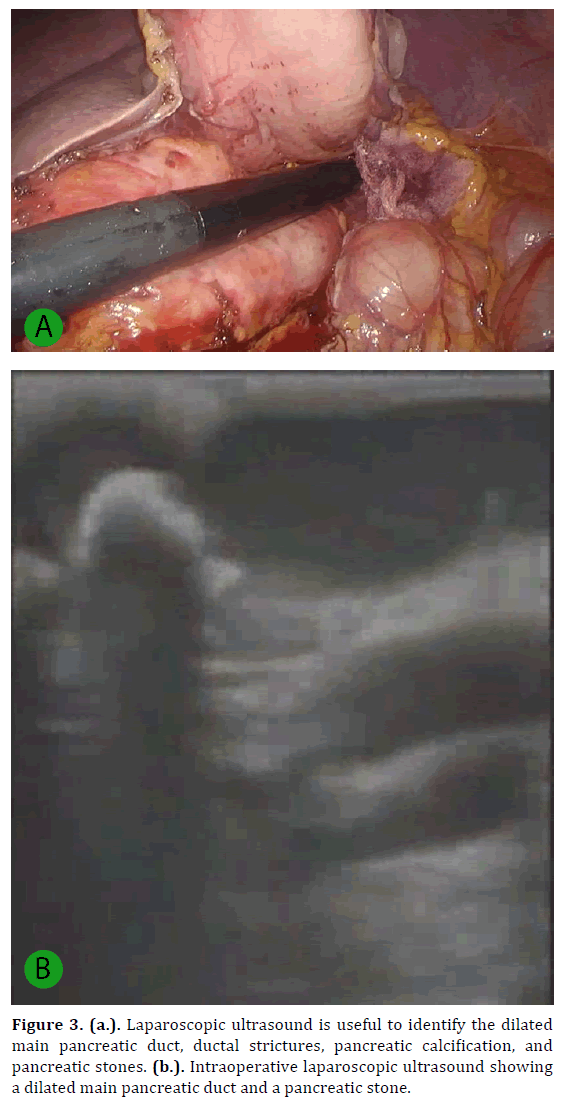 pancreas-laparoscopic-ultrasound-dilated