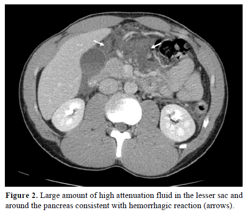 pancreas-large-amount-attenuation