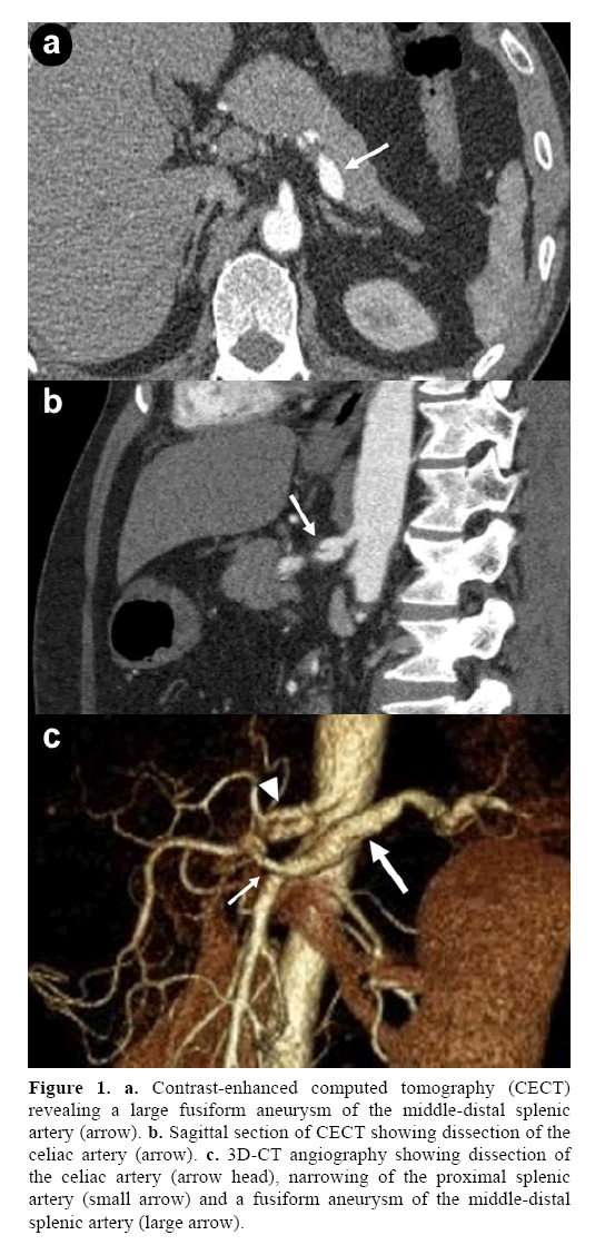 pancreas-large-fusiform-aneurysm