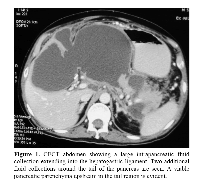 pancreas-large-intrapancreatic-fluid