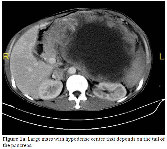 pancreas-large-mass-hypodense