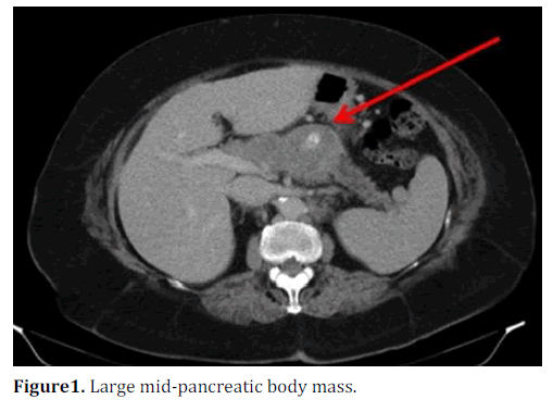 pancreas-large-mid-pancreatic-body