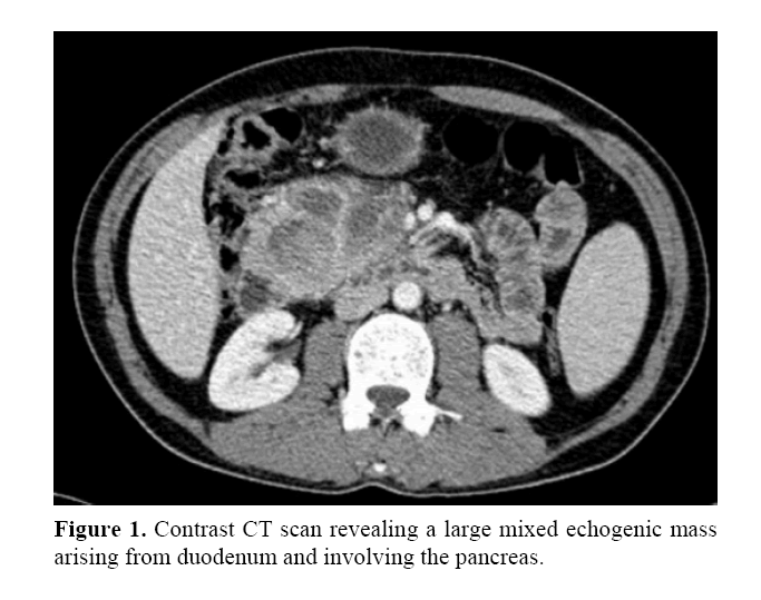 pancreas-large-mixed-echogenic-mass