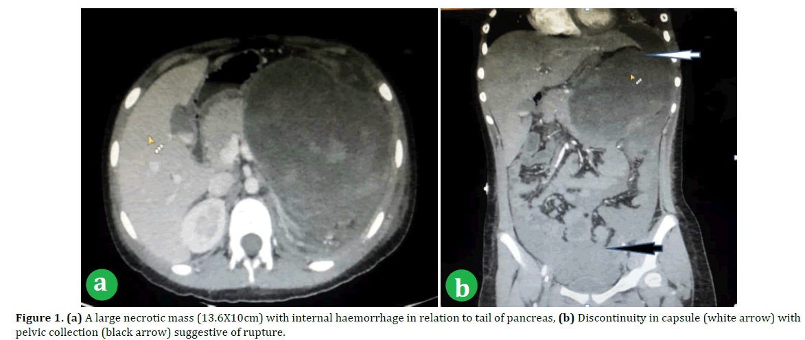 pancreas-large-necrotic