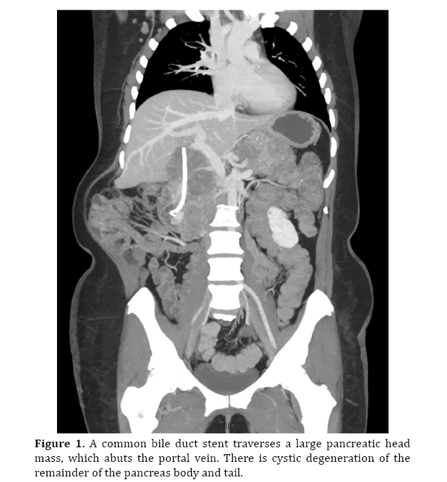 pancreas-large-pancreatic-head