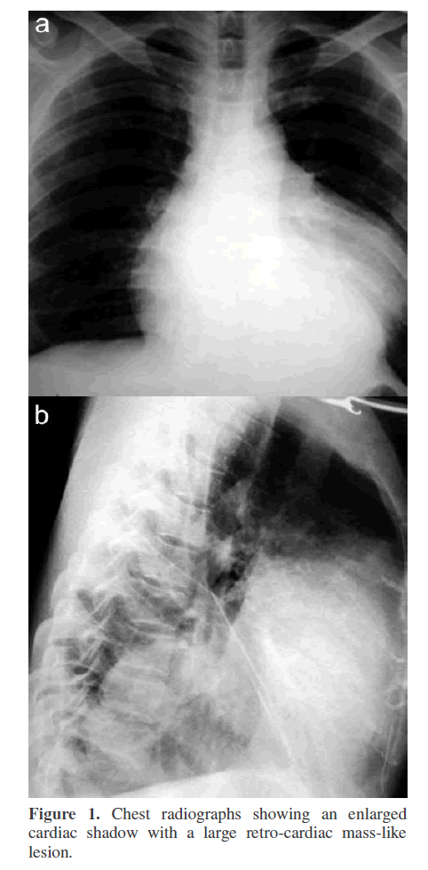 pancreas-large-retro-cardiac-mass-like