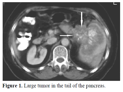 pancreas-large-tumor-tail-pancreas