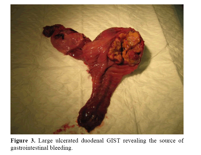 pancreas-large-ulcerated-duodenal