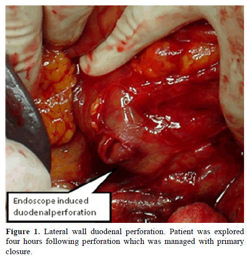 pancreas-lateral-wall-duodenal-perforation