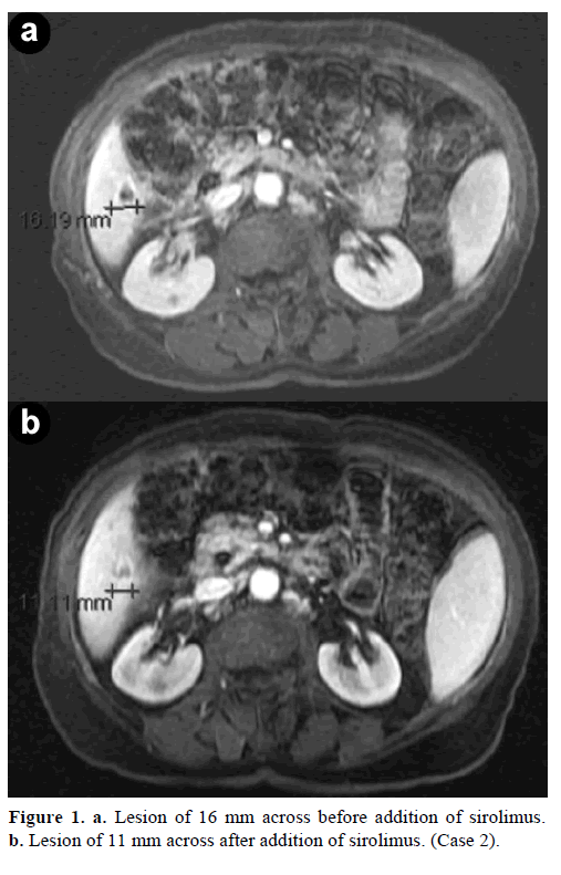 pancreas-lesion-16-mm-addition-sirolimus
