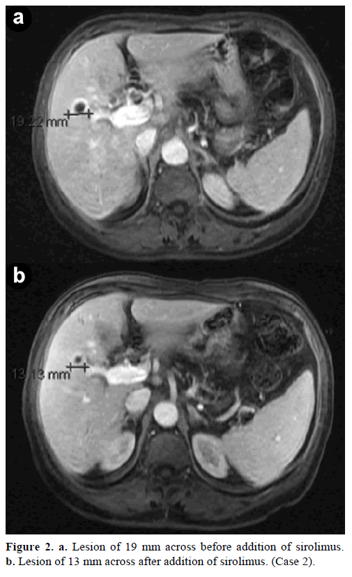 pancreas-lesion-19-mm-addition-sirolimus