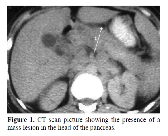 pancreas-lesion-head-pancreas