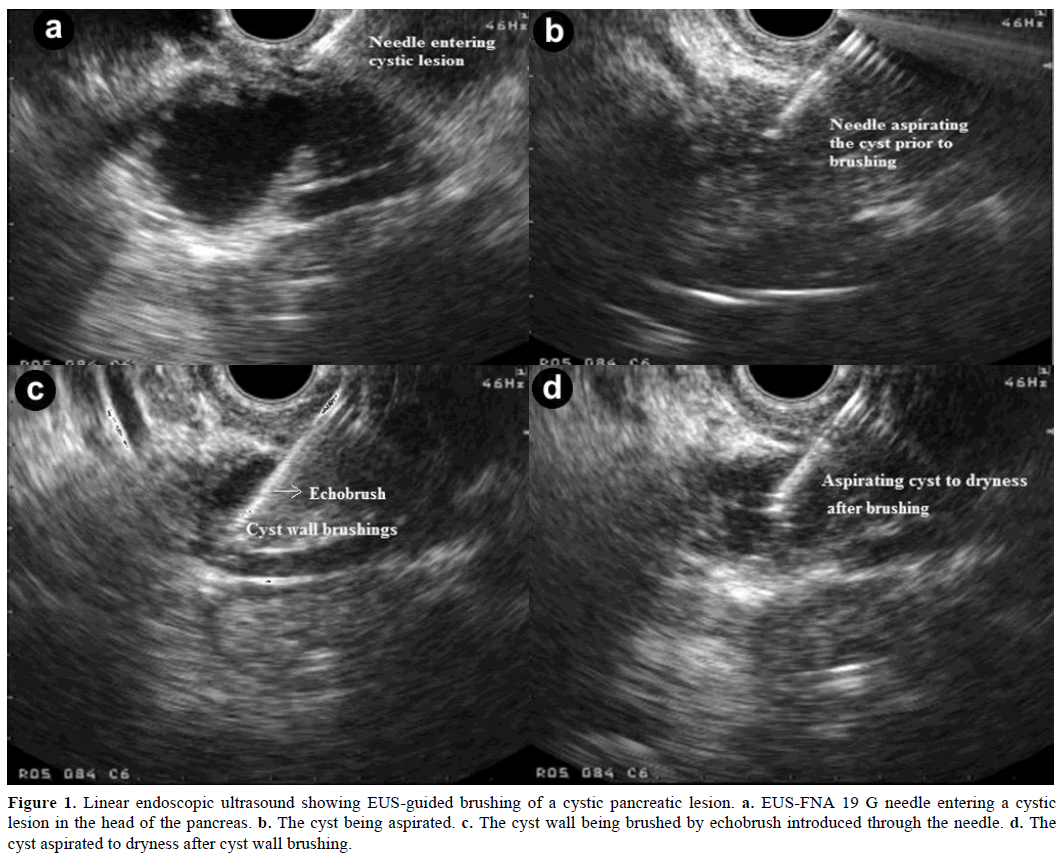 pancreas-linear-endoscopic-ultrasound