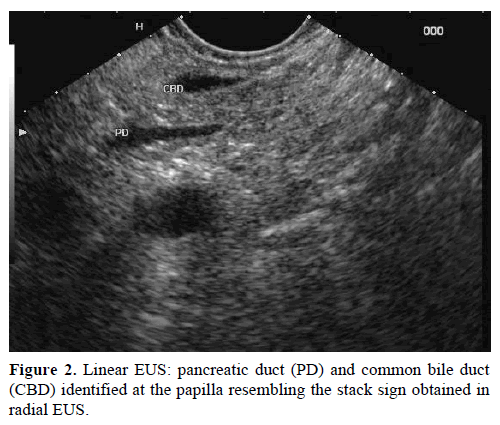 pancreas-linear-eus-common-bile