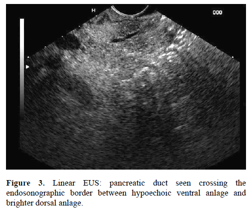 pancreas-linear-eus-endosonographic