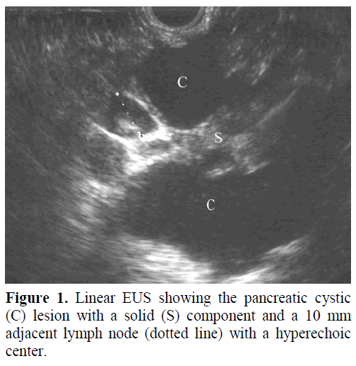 pancreas-linear-eus-pancreatic-cystic