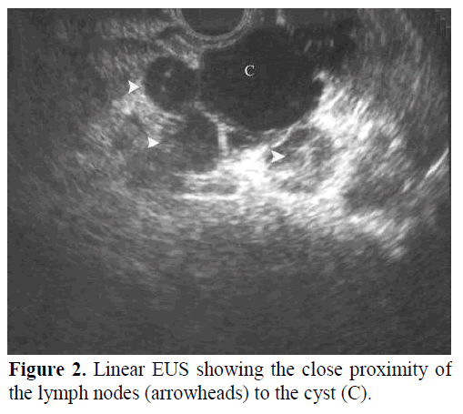 pancreas-linear-eus-proximity-lymph