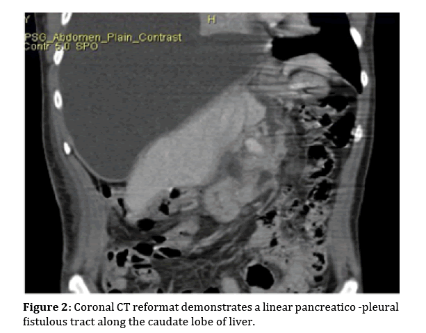 pancreas-linear-pancreatico-pleural